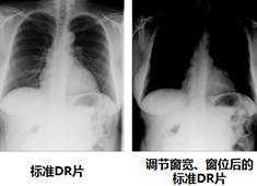 影響DR圖像質量的因素有哪些方面