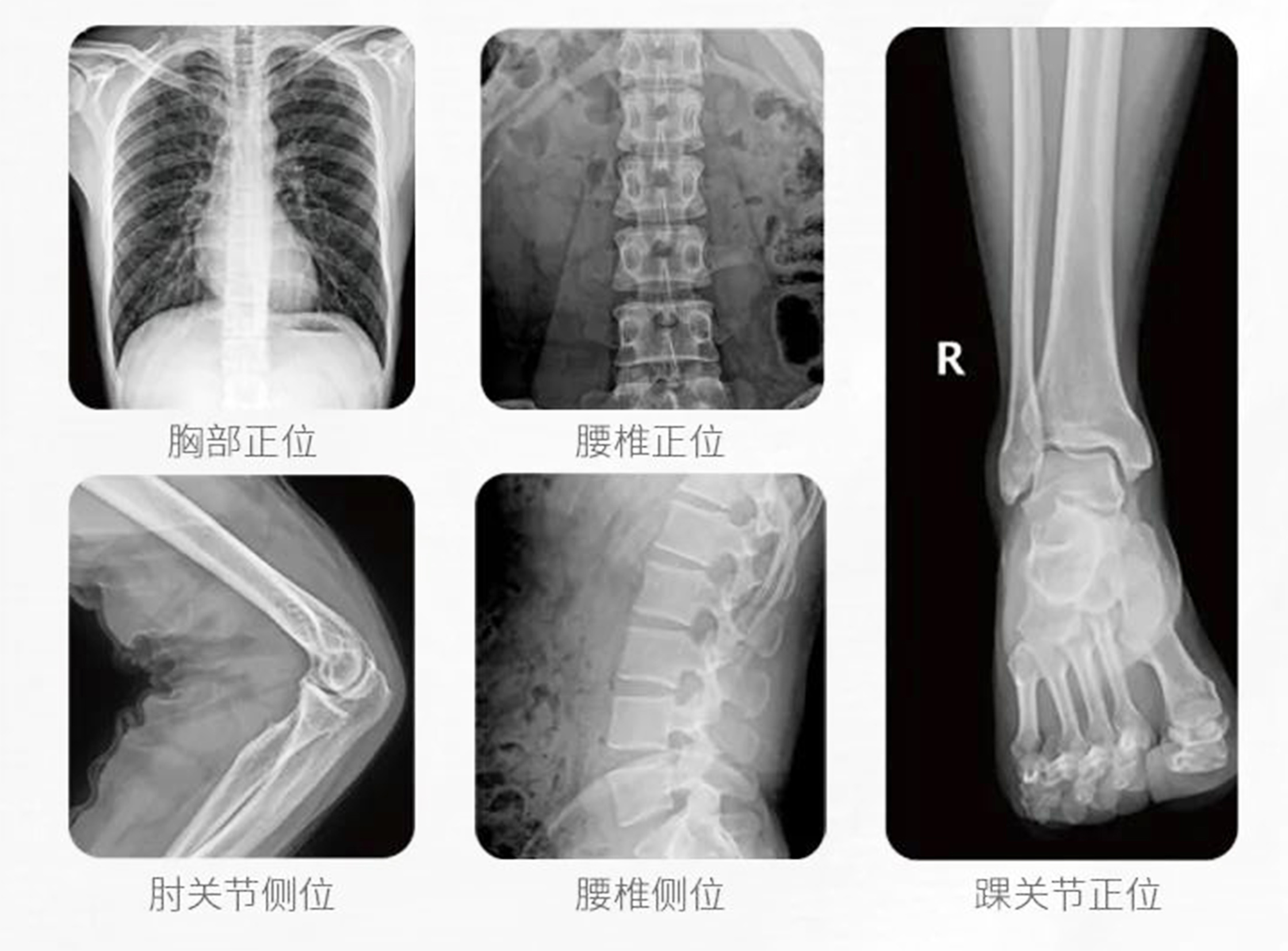 大功率移動DR臨床影像