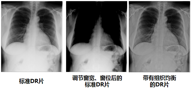 DR圖像質量對比圖